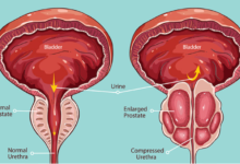 أسباب تضخم البروستاتا