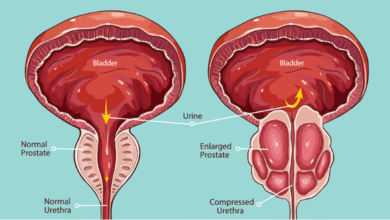 أسباب تضخم البروستاتا