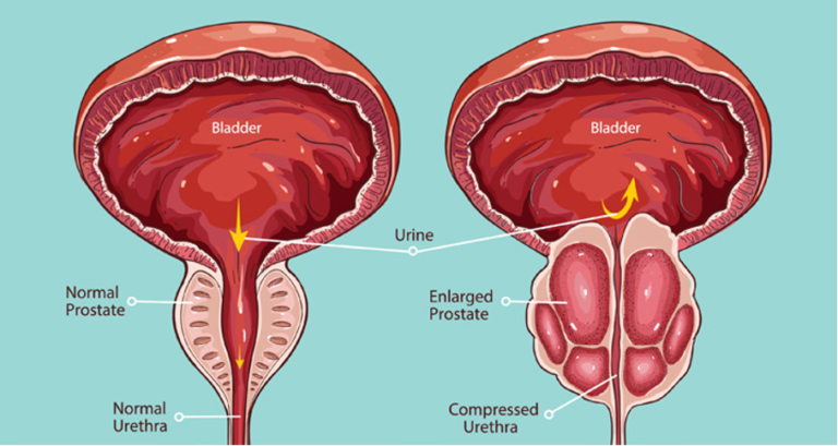 أسباب تضخم البروستاتا