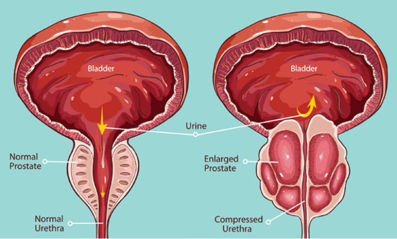 أسباب تضخم البروستاتا