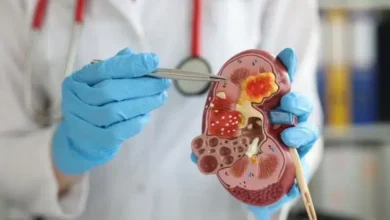 الدكتور محمد ثروت عمارة يكشف عن علامات الإصابة بـ أورام الكلى.. متى يجب زيارة الطبيب؟