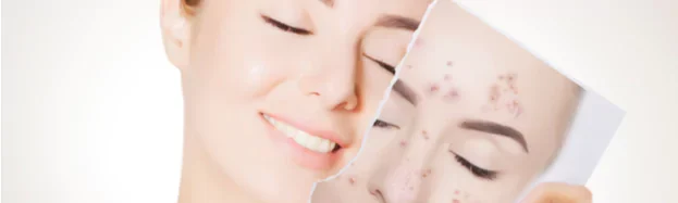 د. هبة حسين تحذّر: تجاهل علاج حب الشباب يترك آثارًا يصعب إزالتها.. متى نلجأ لليزر؟