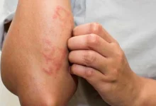 عيالك بيعانوا من الأكزيما؟.. دكتورة هبة حسين تكشف الحل الأمثل لعلاج الأكزيما الجلدية