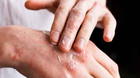 عيالك بيعانوا من الأكزيما؟.. دكتورة هبة حسين تكشف الحل الأمثل لعلاج الأكزيما الجلدية