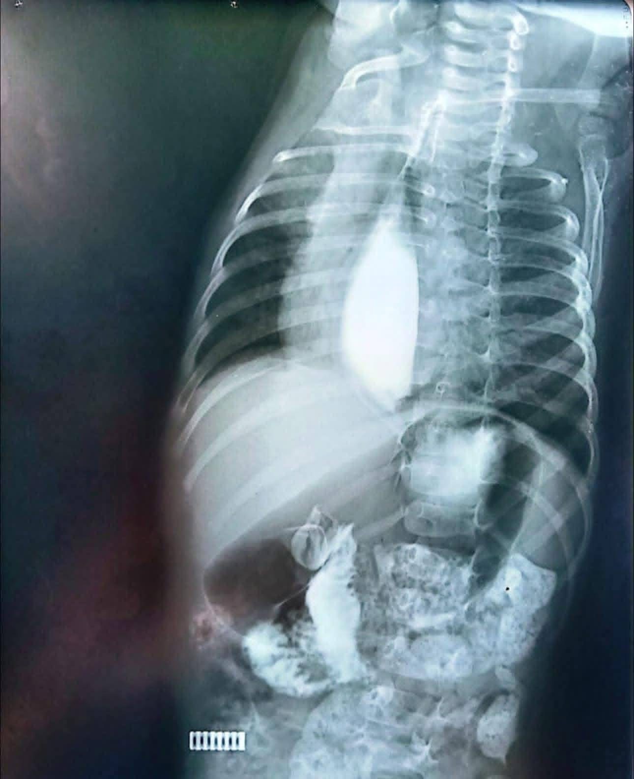 أطباء مصر.. فخر العالم العربي يكتبون التاريخ بواحدة من أندر العمليات في الشرق الأوسط 