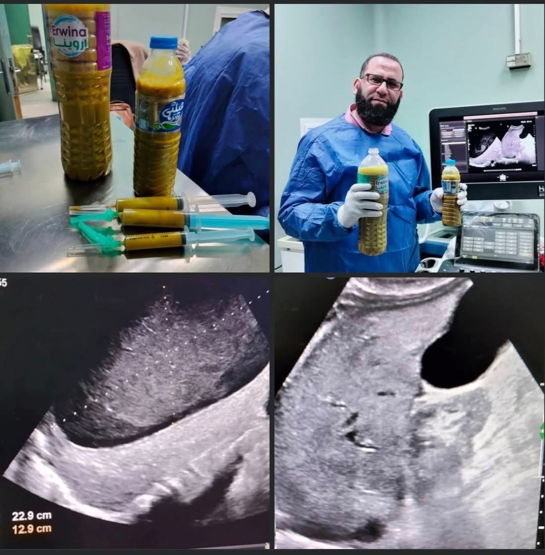 شكر الله الطب والأطباء.. د. السيد إمام يستخرج 4 لتر صديد من كبد عجوز | صورة