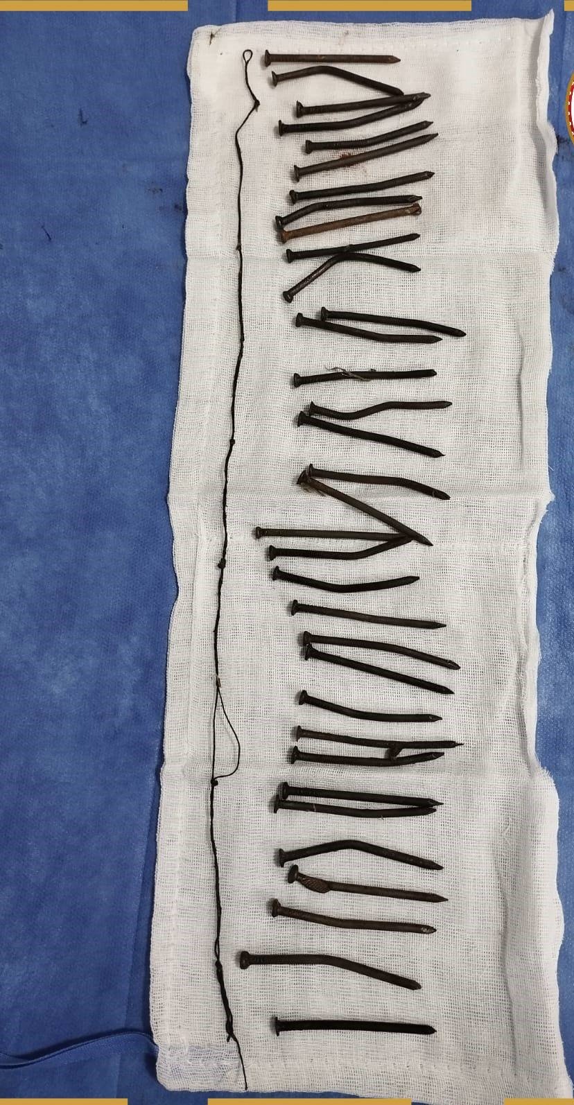 معجزة طبية.. فريق طبي ينجح في إزالة 34 مسمارًا من معدة مريضة