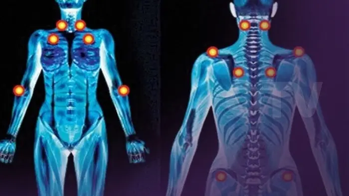 آلام بلا سبب عضوي.. كيف تسرق الفيبروميالجيا الصحة في صمت؟