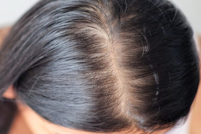 تساقط الشعر مش مشكلة مستحيلة.. دكتورة هبة حسين تكشف الطريقة المثلى