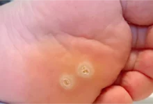 د. هبة حسين: عين السمكة مش بس للأطفال.. البالغين معرضين لها كمان| أحدث طرق للعلاج فعالة