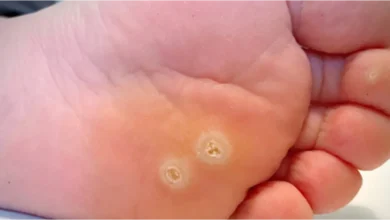 د. هبة حسين: عين السمكة مش بس للأطفال.. البالغين معرضين لها كمان| أحدث طرق للعلاج فعالة